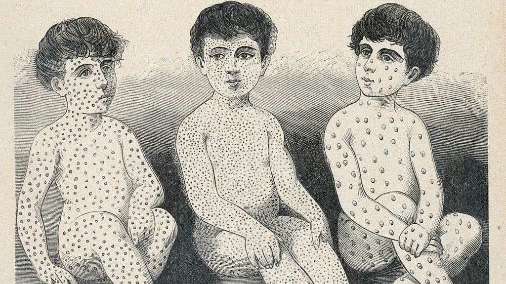 Immune Amnesia – How Measles Disrupts our Immune System